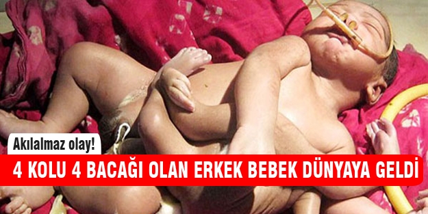 4 kolu 4 bacağı olan bebek!