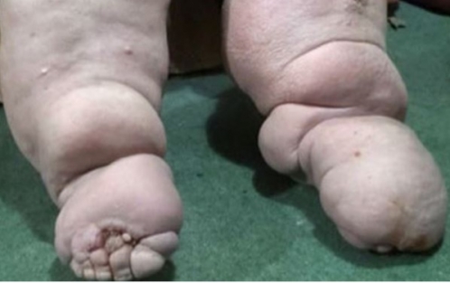 Memur fil hastalığına yakalandı 130 kilo oldu