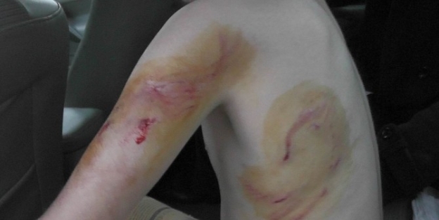 Köpeğin Isirdiği Çocuk Hastanelik Oldu