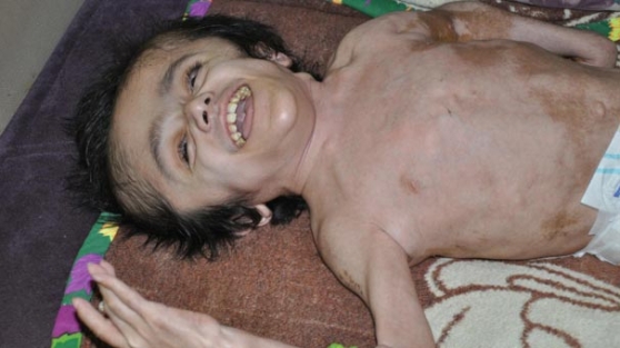 Hidrosefali hastasına evde bakım şoku