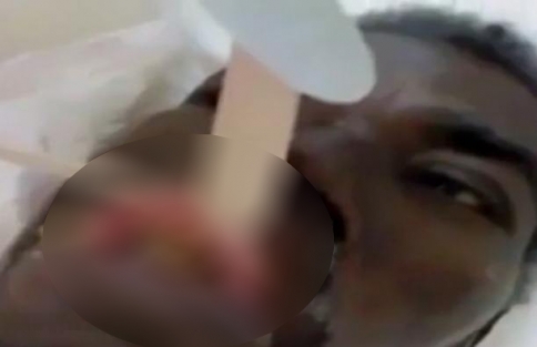 Dudağının içinden çıkanlar doktorları bile şok etti!