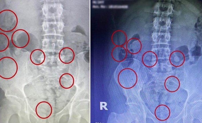 Mide ve bağırsağındaki uyuşturucu röntgende ortaya çıktı!