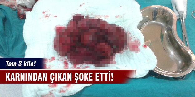 Karnından çıkan şoke etti! Tam 3 kilo