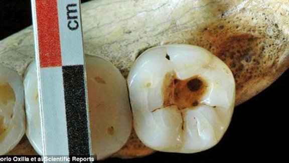 14 bin yıl önceki diş tedavisi