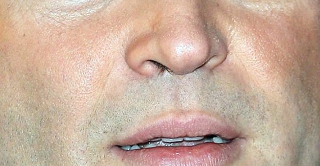 Burun deliğinden 2 taş çıktı!