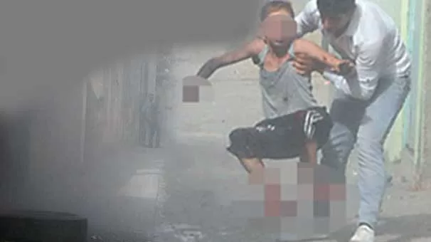 12 yaşındaki çocuk bir el ve ayağını kaybetti