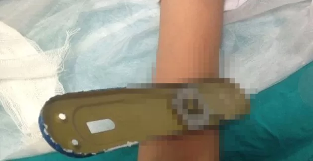 Çorum'da 11 yaşındaki çocuğun koluna kap kolu saplandı