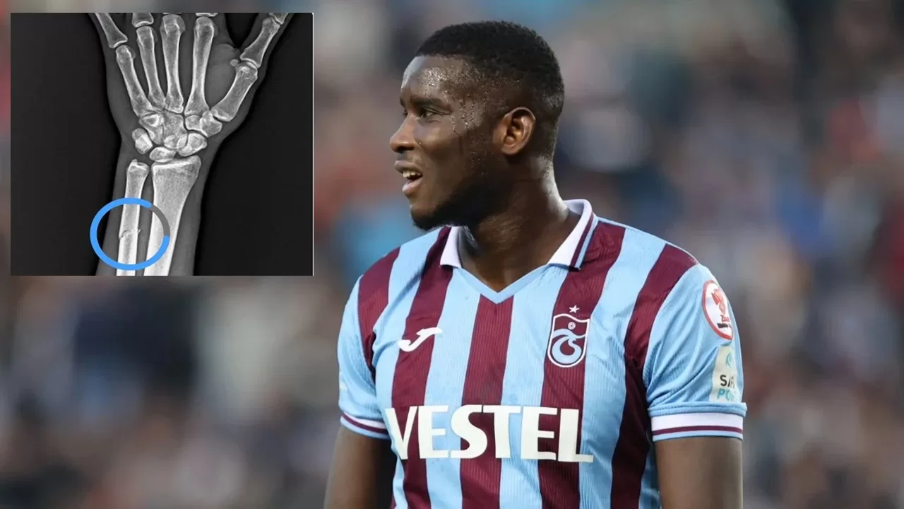 Trabzonspor Onuachu'nun Kolundaki Kırık Röntgeniyle Açıklama Yaptı