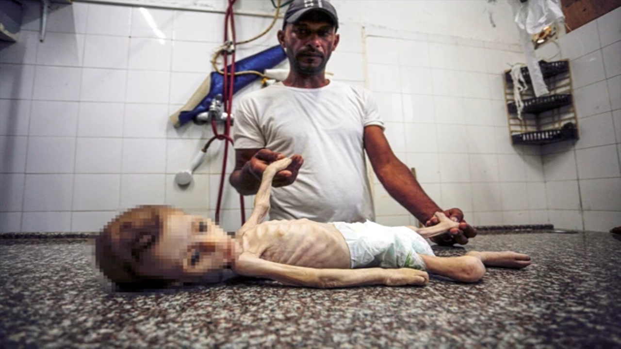 Gazze'de 7 Aylık Bebek, Yetersiz Beslenme ve Tıbbi Malzeme Eksikliği Nedeniyle Hayatını Kaybetti