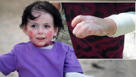 Deri hastası  Rafaella'nın büyük dramı!