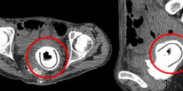 Vajinasında, vibratör unuttu!