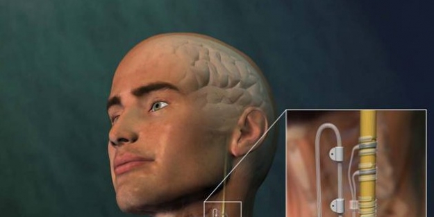 Epilepsi Nöbetlerine “pilli” Çözüm