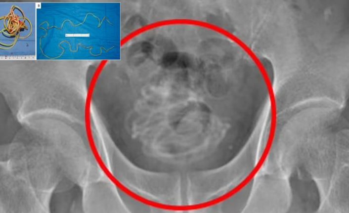 Penisinden 2 metrelik atlama ipi çıkarıldı!