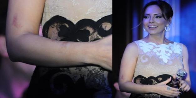 Ebru Gündeş'in kolundaki morluklar şok etti!